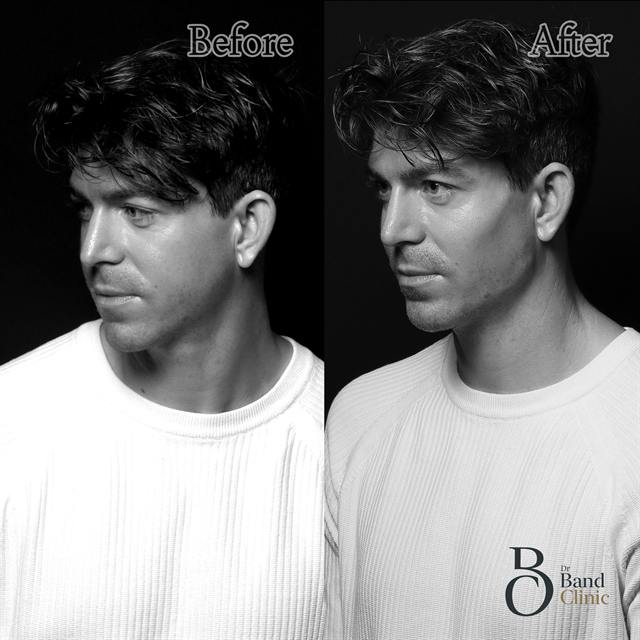 Unretouched before and after result, the drBand Clinic