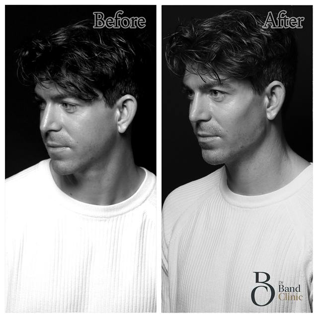 Unretouched before and after result, the drBand Clinic