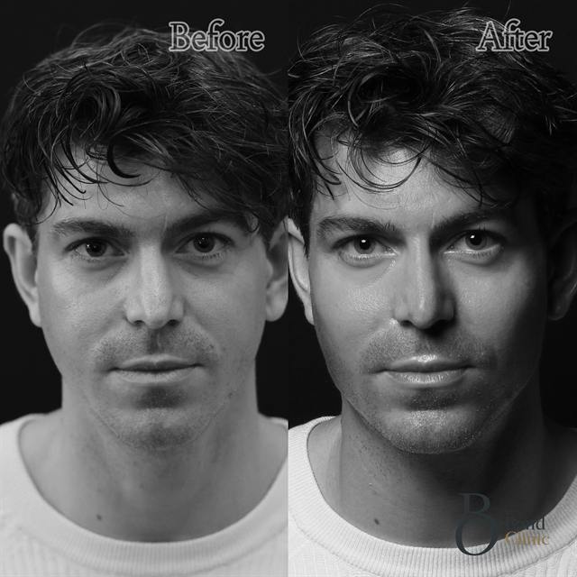 Unretouched before and after result, the drBand Clinic