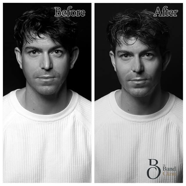 Unretouched before and after result, the drBand Clinic