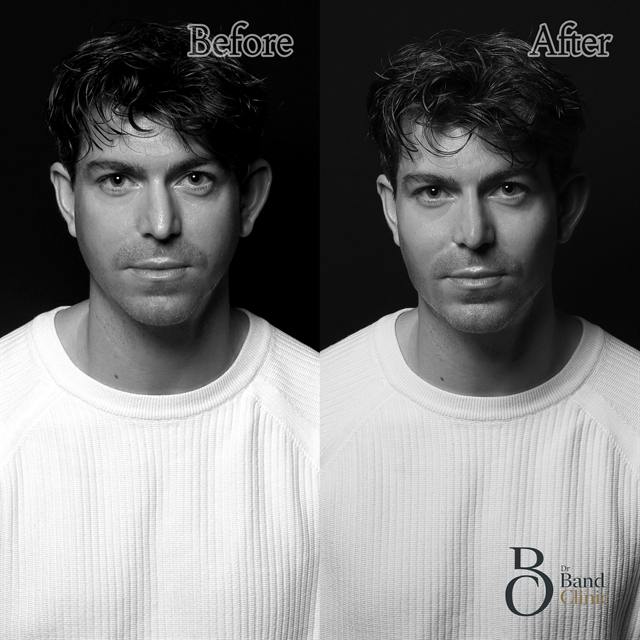 Unretouched before and after result, the drBand Clinic