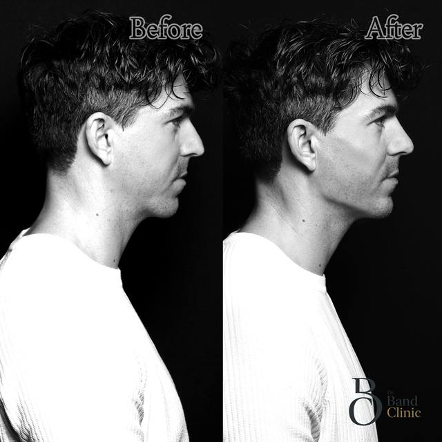 Unretouched before and after result, the drBand Clinic