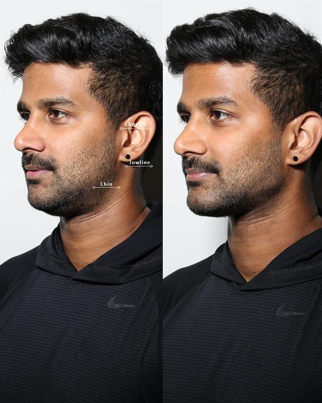 Unretouched before and after result, the drBand Clinic
