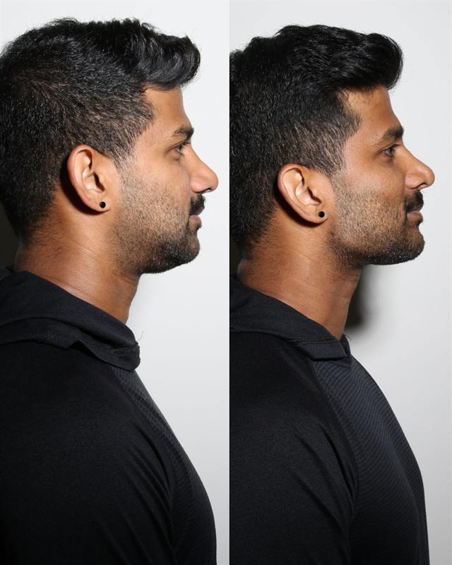 Unretouched before and after result, the drBand Clinic