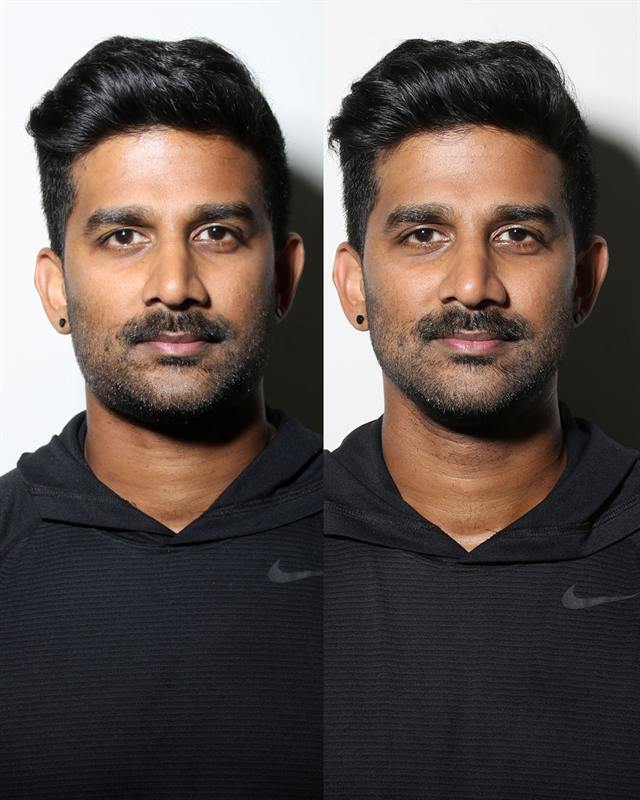 Unretouched before and after result, the drBand Clinic
