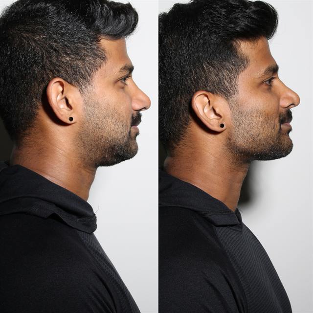 Unretouched before and after result, the drBand Clinic