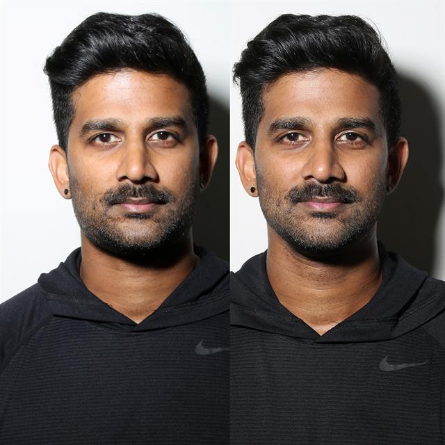 Unretouched before and after result, the drBand Clinic
