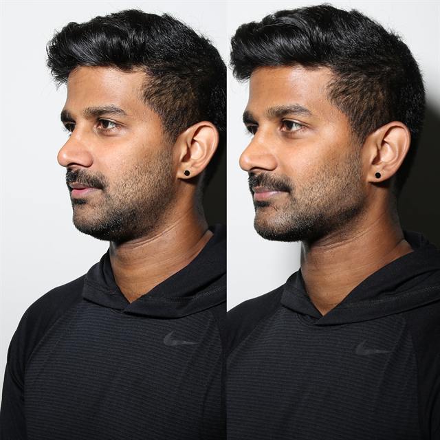 Unretouched before and after result, the drBand Clinic