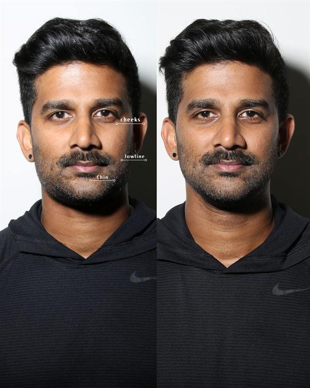 Unretouched before and after result, the drBand Clinic