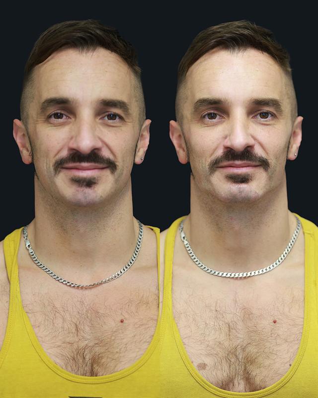 Unretouched before and after result, the drBand Clinic