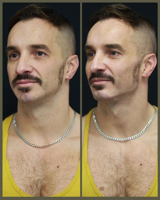 Unretouched before and after result, the drBand Clinic