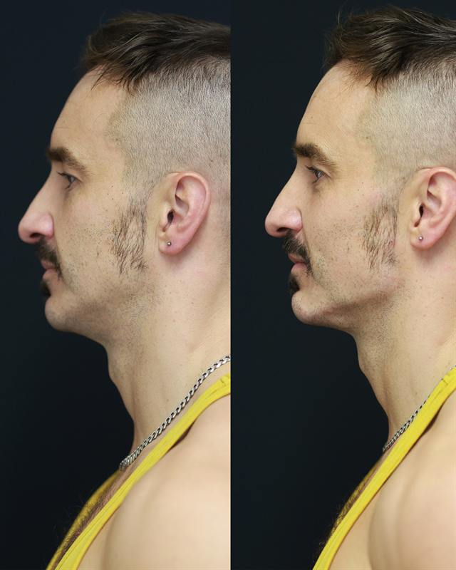 Unretouched before and after result, the drBand Clinic
