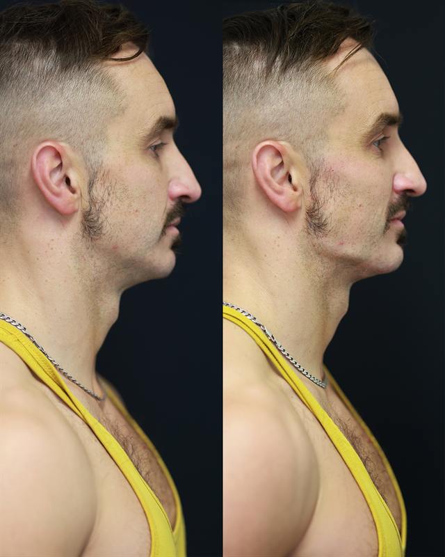 Unretouched before and after result, the drBand Clinic