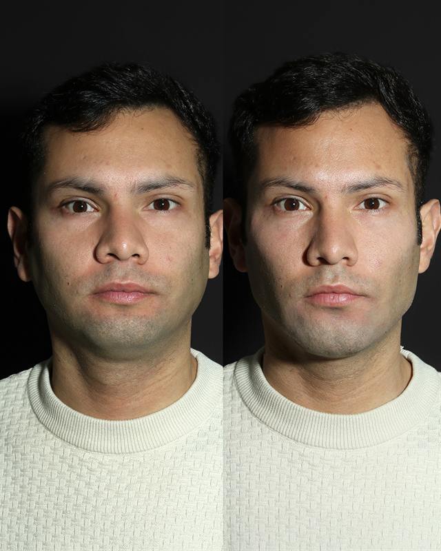 Unretouched before and after result, the drBand Clinic