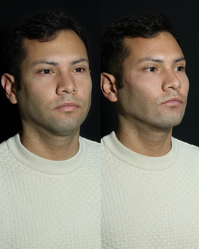 Unretouched before and after result, the drBand Clinic