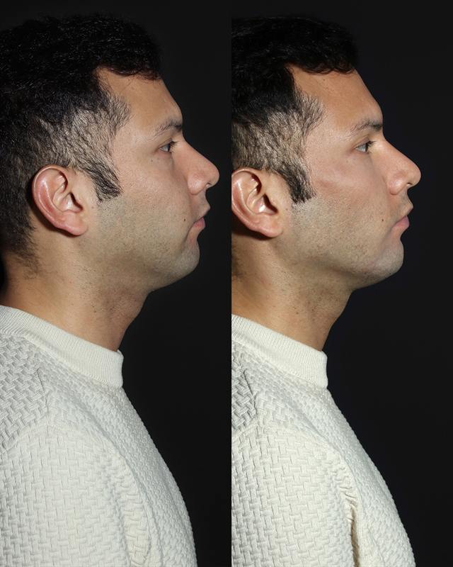Unretouched before and after result, the drBand Clinic