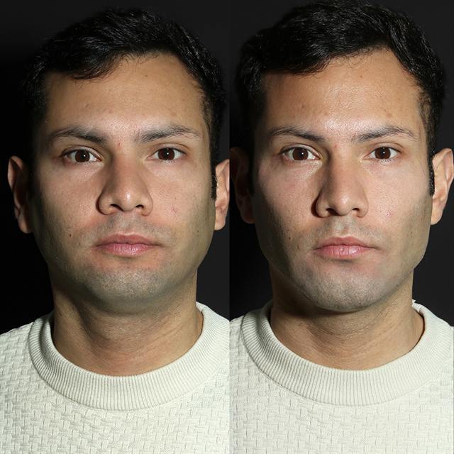 Unretouched before and after result, the drBand Clinic