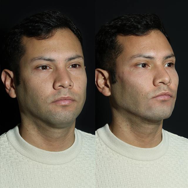 Unretouched before and after result, the drBand Clinic