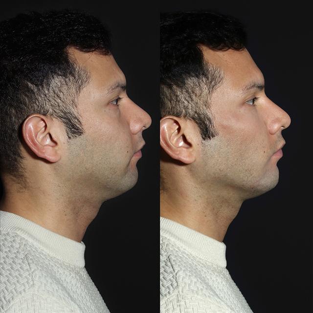 Unretouched before and after result, the drBand Clinic