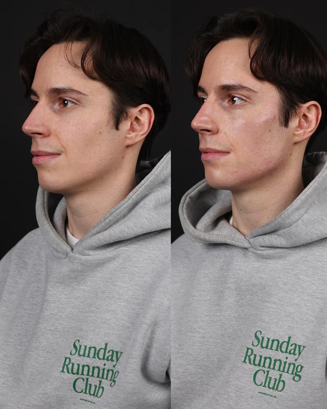 Unretouched before and after result, the drBand Clinic