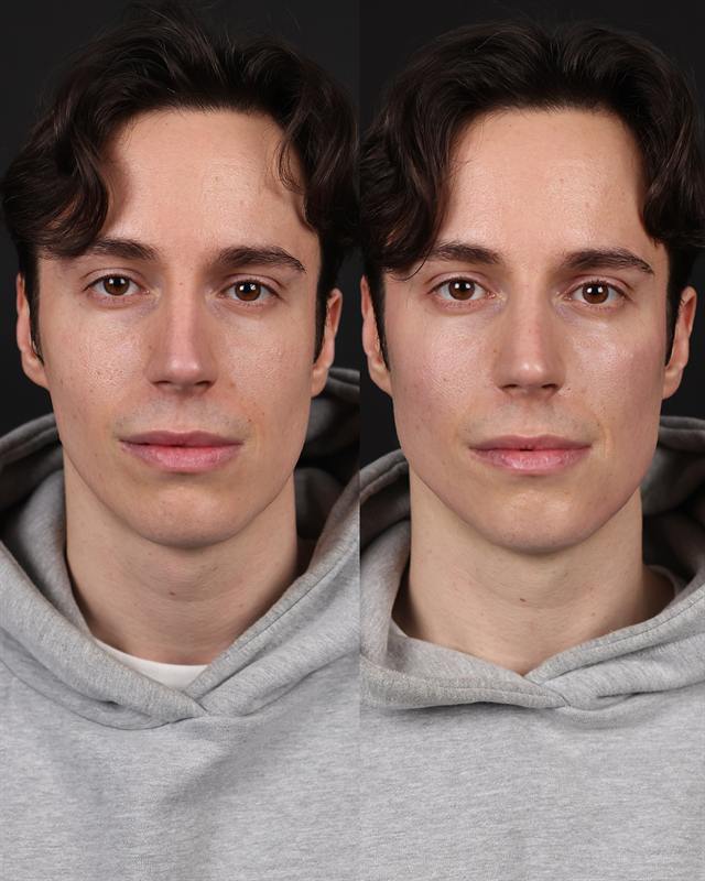 Unretouched before and after result, the drBand Clinic