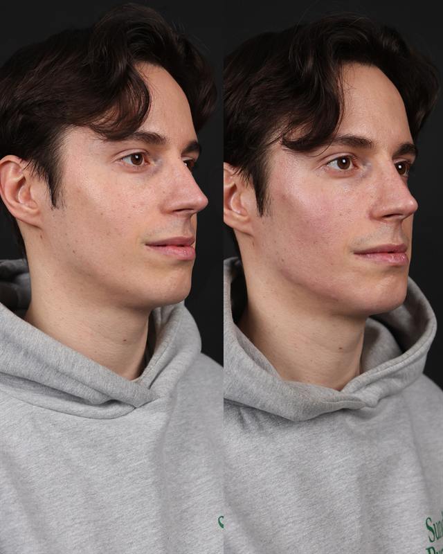 Unretouched before and after result, the drBand Clinic