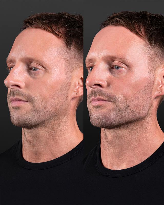 Unretouched before and after result, the drBand Clinic