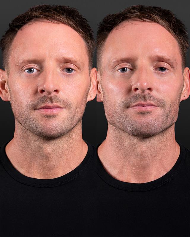 Unretouched before and after result, the drBand Clinic