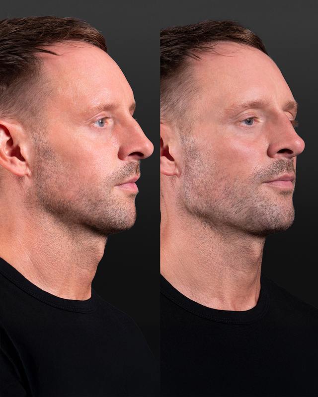 Unretouched before and after result, the drBand Clinic