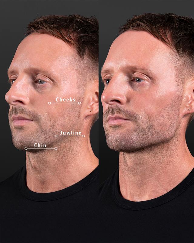 Unretouched before and after result, the drBand Clinic