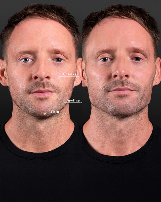 Unretouched before and after result, the drBand Clinic