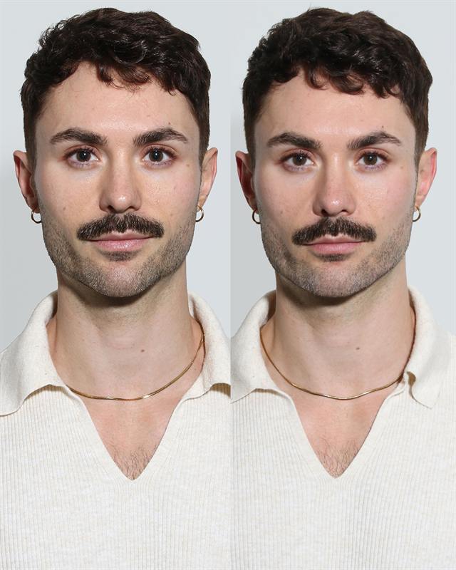 Unretouched before and after result, the drBand Clinic