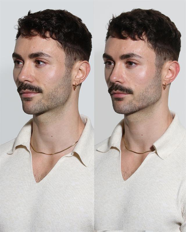Unretouched before and after result, the drBand Clinic