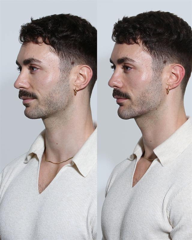 Unretouched before and after result, the drBand Clinic