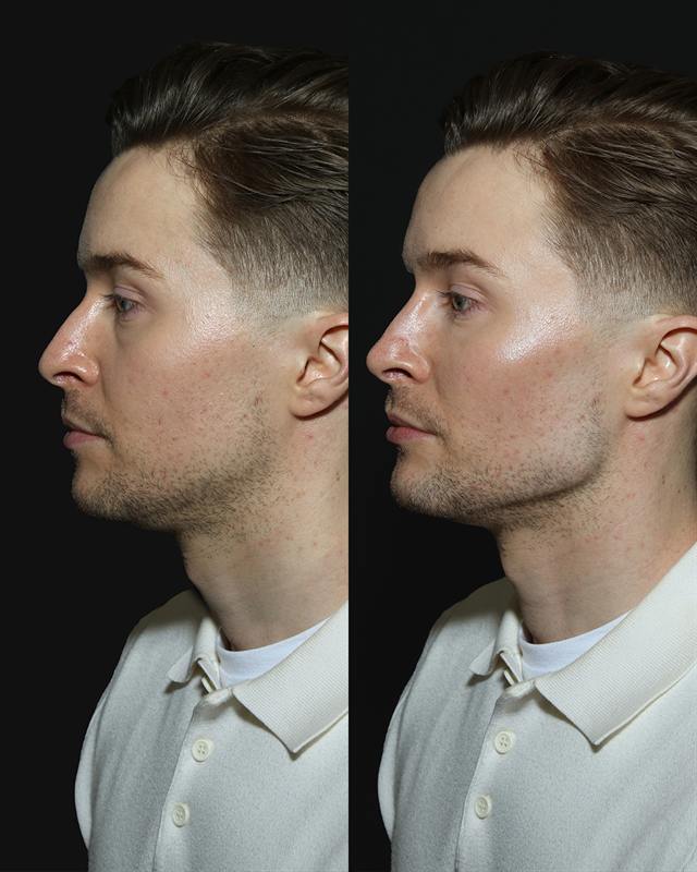 Unretouched before and after result, the drBand Clinic