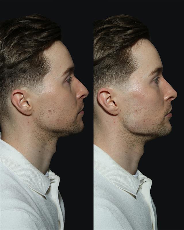 Unretouched before and after result, the drBand Clinic