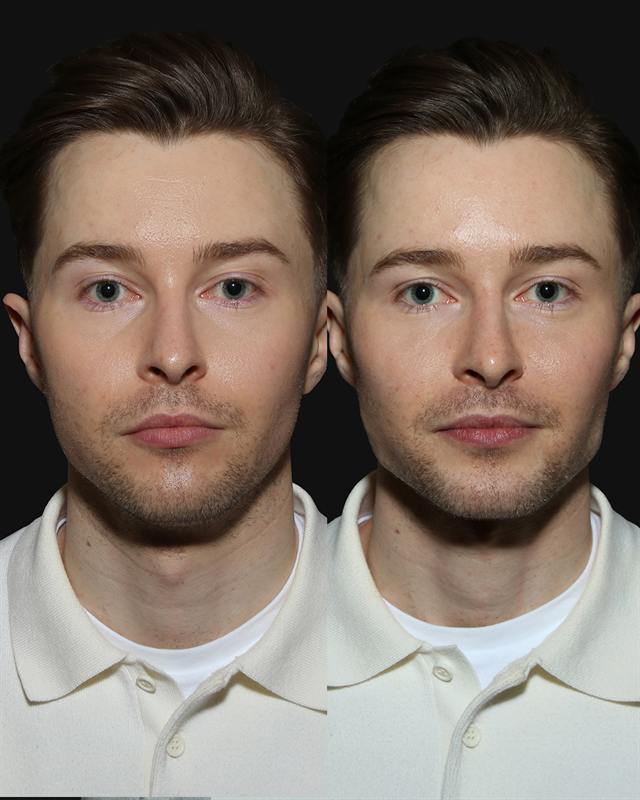 Unretouched before and after result, the drBand Clinic