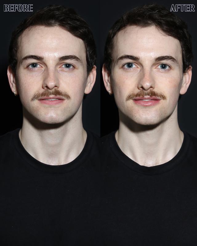 Unretouched before and after result, the drBand Clinic