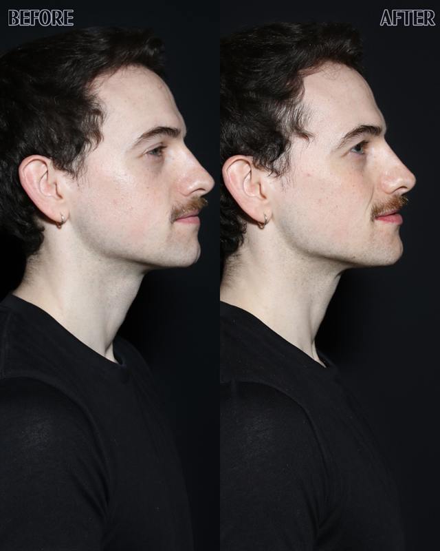 Unretouched before and after result, the drBand Clinic