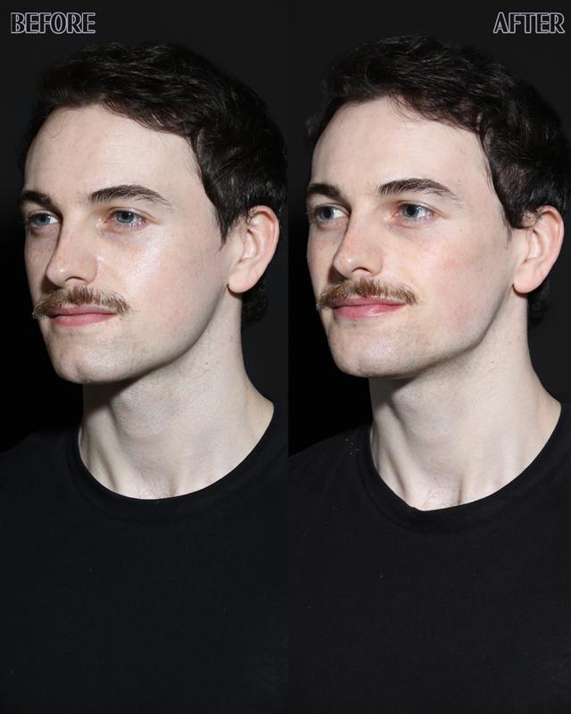 Unretouched before and after result, the drBand Clinic