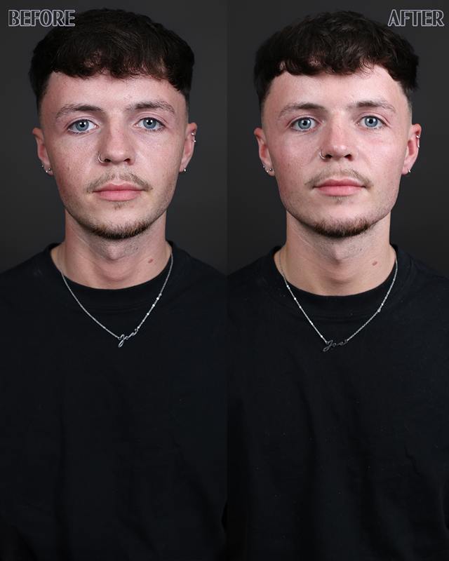 Unretouched before and after result, the drBand Clinic