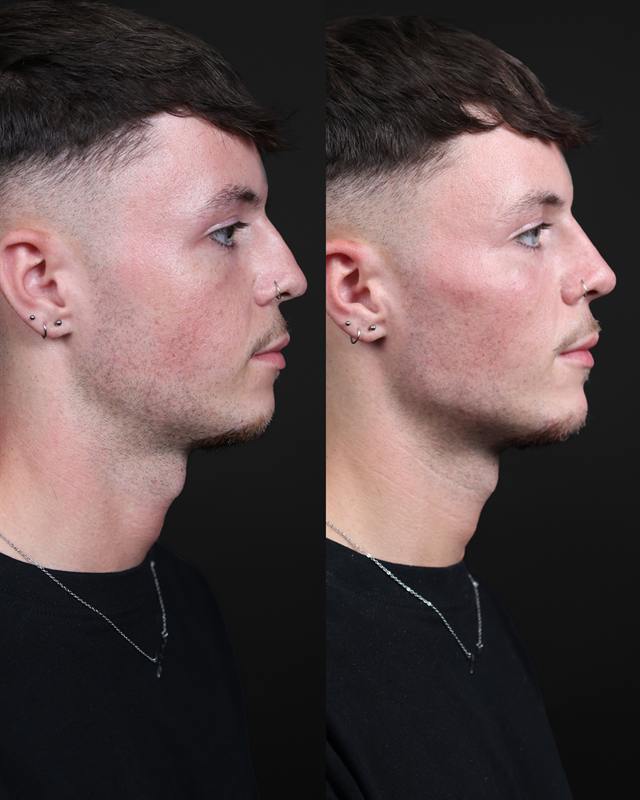 Unretouched before and after result, the drBand Clinic