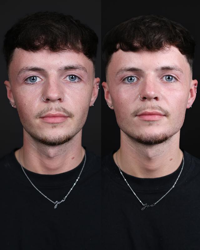 Unretouched before and after result, the drBand Clinic