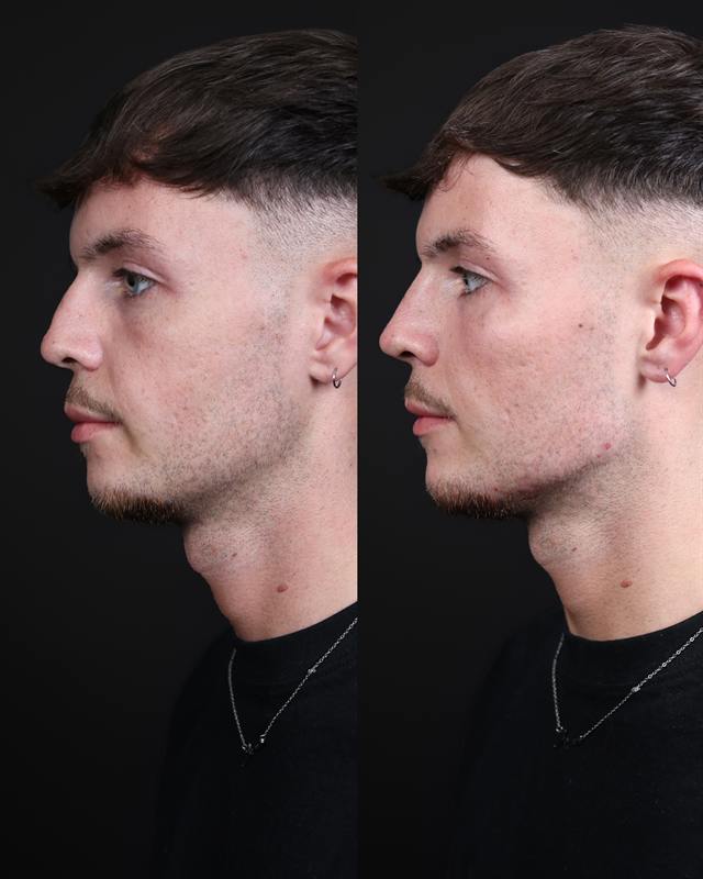 Unretouched before and after result, the drBand Clinic