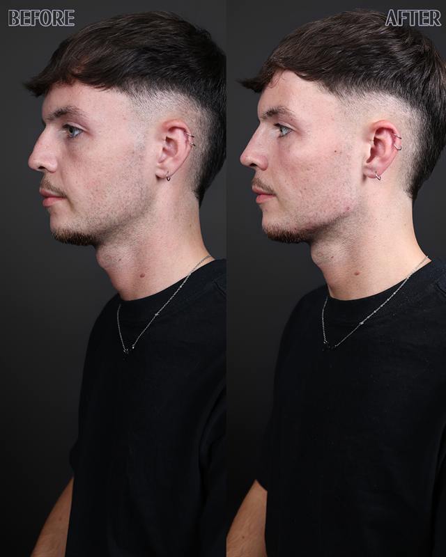 Unretouched before and after result, the drBand Clinic