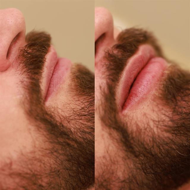 Unretouched before and after result, the drBand Clinic