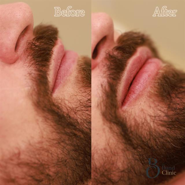 Unretouched before and after result, the drBand Clinic