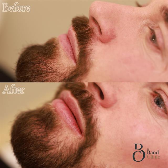 Unretouched before and after result, the drBand Clinic