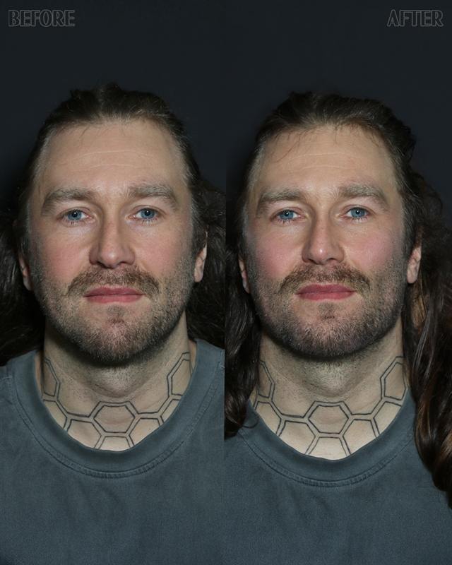Unretouched before and after result, the drBand Clinic