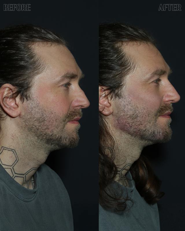 Unretouched before and after result, the drBand Clinic